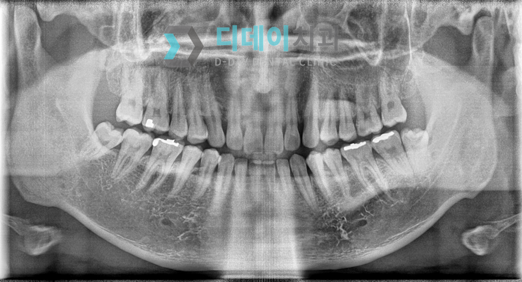 사랑니 발치 전 파노라마 방사선 사진입니다.