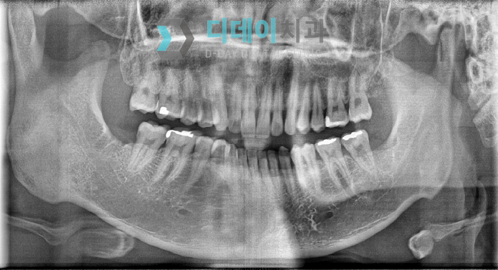 사랑니 발치 후 파노라마 방사선 사진입니다.