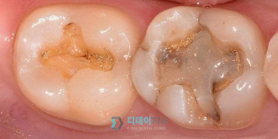 기존 아말감과 골드인레이를 제거한 후 사진입니다.