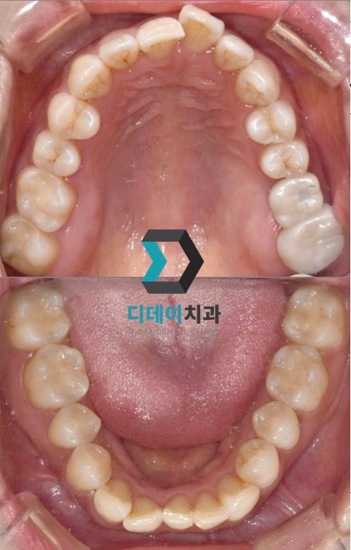 치료 후 사진입니다.